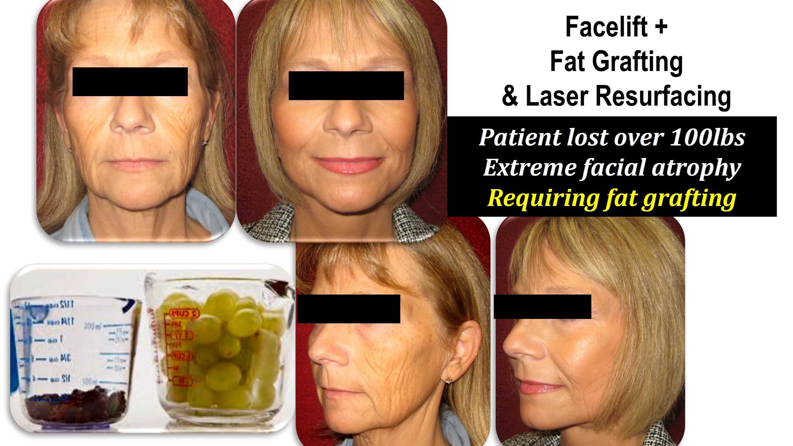 before and after face fat graf